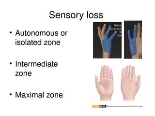 Sensory loss
• Autonomous or
isolated zone
• Intermediate
zone
• Maximal zone
 