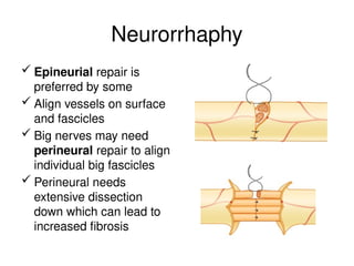 Neurorrhaphy
 Epineurial repair is
preferred by some
 Align vessels on surface
and fascicles
 Big nerves may need
perineural repair to align
individual big fascicles
 Perineural needs
extensive dissection
down which can lead to
increased fibrosis
 
