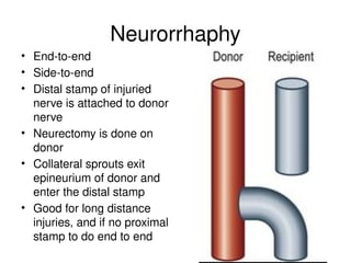 Neurorrhaphy
• End-to-end
• Side-to-end
• Distal stamp of injuried
nerve is attached to donor
nerve
• Neurectomy is done on
donor
• Collateral sprouts exit
epineurium of donor and
enter the distal stamp
• Good for long distance
injuries, and if no proximal
stamp to do end to end
 