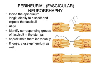 PERINEURIAL (FASCICULAR)
NEURORRHAPHY
• Incise the epineurium
longitudinally to dissect and
expose the fasciculi
• Align
• Identify corresponding groups
of fasciculi in the stumps
• approximate them individually
• If loose, close epineurium as
well
 