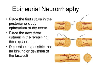 Epineurial Neurorrhaphy
• Place the first suture in the
posterior or deep
epineurium of the nerve
• Place the next three
sutures in the remaining
three quadrants
• Determine as possible that
no kinking or deviation of
the fasciculi
 