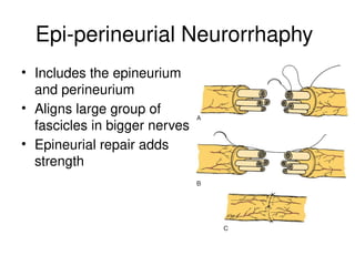 Epi-perineurial Neurorrhaphy
• Includes the epineurium
and perineurium
• Aligns large group of
fascicles in bigger nerves
• Epineurial repair adds
strength
 