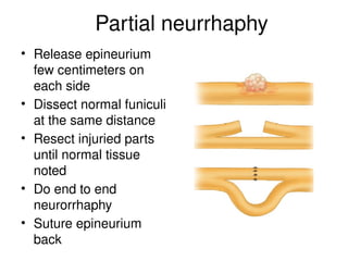 Partial neurrhaphy
• Release epineurium
few centimeters on
each side
• Dissect normal funiculi
at the same distance
• Resect injuried parts
until normal tissue
noted
• Do end to end
neurorrhaphy
• Suture epineurium
back
 