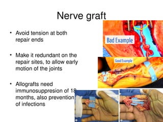 Nerve graft
• Avoid tension at both
repair ends
• Make it redundant on the
repair sites, to allow early
motion of the joints
• Allografts need
immunosuppresion of 18
months, also prevention
of infections
 