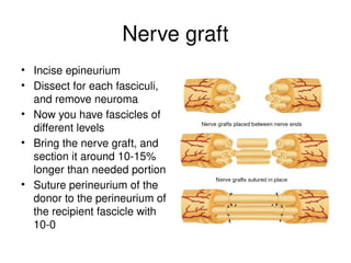 Nerve graft
• Incise epineurium
• Dissect for each fasciculi,
and remove neuroma
• Now you have fascicles of
different levels
• Bring the nerve graft, and
section it around 10-15%
longer than needed portion
• Suture perineurium of the
donor to the perineurium of
the recipient fascicle with
10-0
 