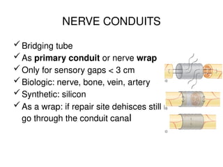 NERVE CONDUITS
Bridging tube
As primary conduit or nerve wrap
Only for sensory gaps < 3 cm
Biologic: nerve, bone, vein, artery
Synthetic: silicon
As a wrap: if repair site dehisces still nerve can
go through the conduit canal
 