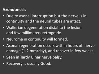 Axonotmesis
• Due to axonal interruption but the nerve is in
continuity and the neural tubes are intact.
• Wallerian degeneration distal to the lesion
and few millimeters retrograde.
• Neuroma in continuity will formed.
• Axonal regeneration occurs within hours of nerve
damage (1-2 mm/day), and recover in few weeks.
• Seen in Tardy Ulnar nerve palsy.
• Recovery is usually Good.
 