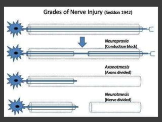 Peripheral Nerve Injury (Part-I)