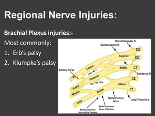 Regional Nerve Injuries:
Brachial Plexus injuries:-
Most commonly:
1. Erb’s palsy
2. Klumpke’s palsy
 