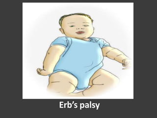 Erb’s palsy
 