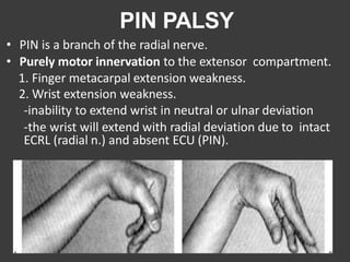 PIN PALSY
• PIN is a branch of the radial nerve.
• Purely motor innervation to the extensor compartment.
1. Finger metacarpal extension weakness.
2. Wrist extension weakness.
-inability to extend wrist in neutral or ulnar deviation
-the wrist will extend with radial deviation due to intact
ECRL (radial n.) and absent ECU (PIN).
 