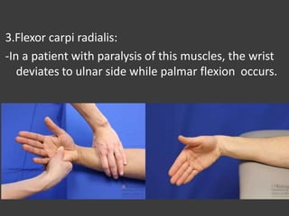 3.Flexor carpi radialis:
-In a patient with paralysis of this muscles, the wrist
deviates to ulnar side while palmar flexion occurs.
 