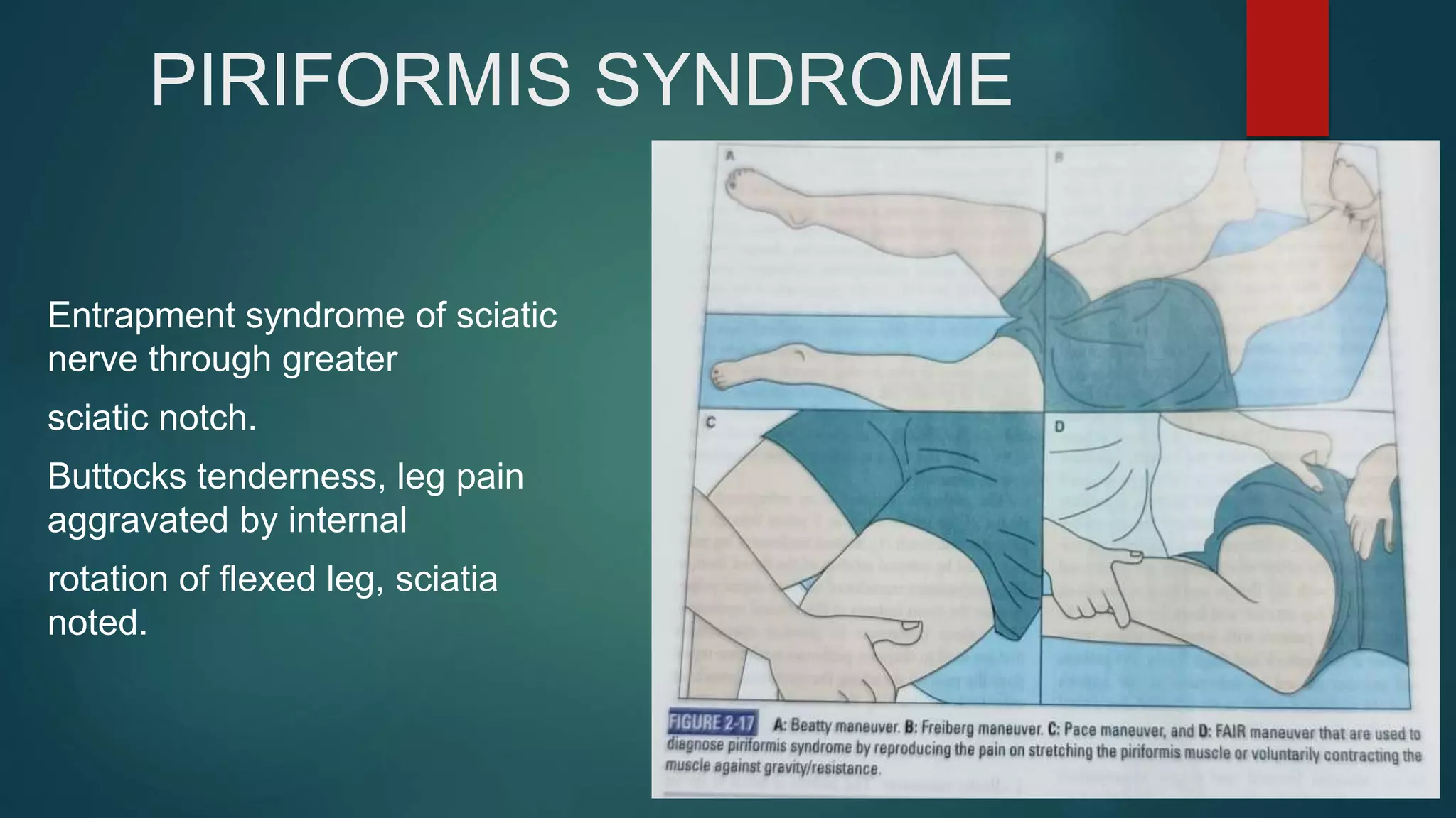 PIRIFORMIS SYNDROME
Entrapment syndrome of sciatic
nerve through greater
sciatic notch.
Buttocks tenderness, leg pain
aggravated by internal
rotation of flexed leg, sciatia
noted.
 