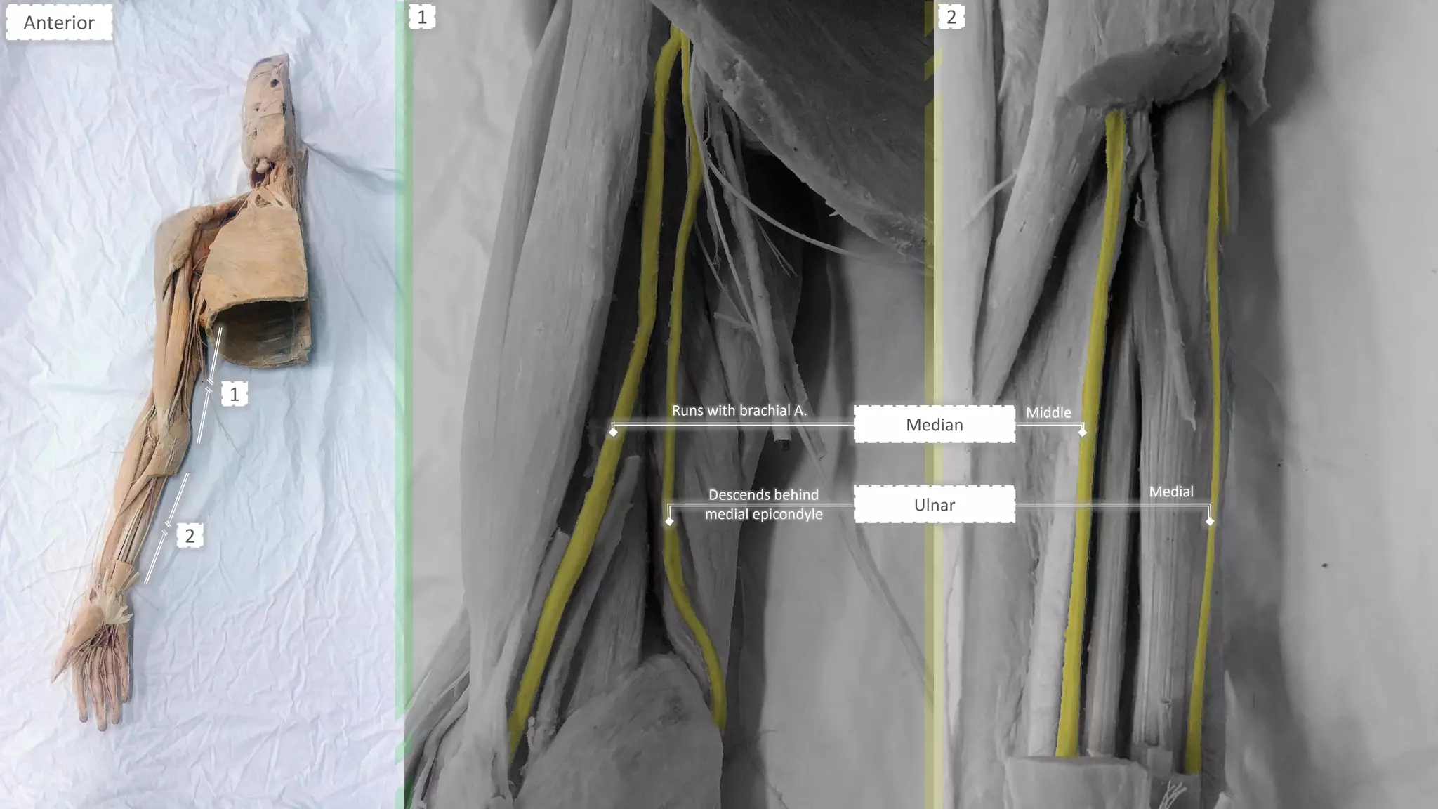 Anterior
1
2
1 2
Ulnar
Median
Runs with brachial A.
Descends behind
medial epicondyle
Medial
Middle
 