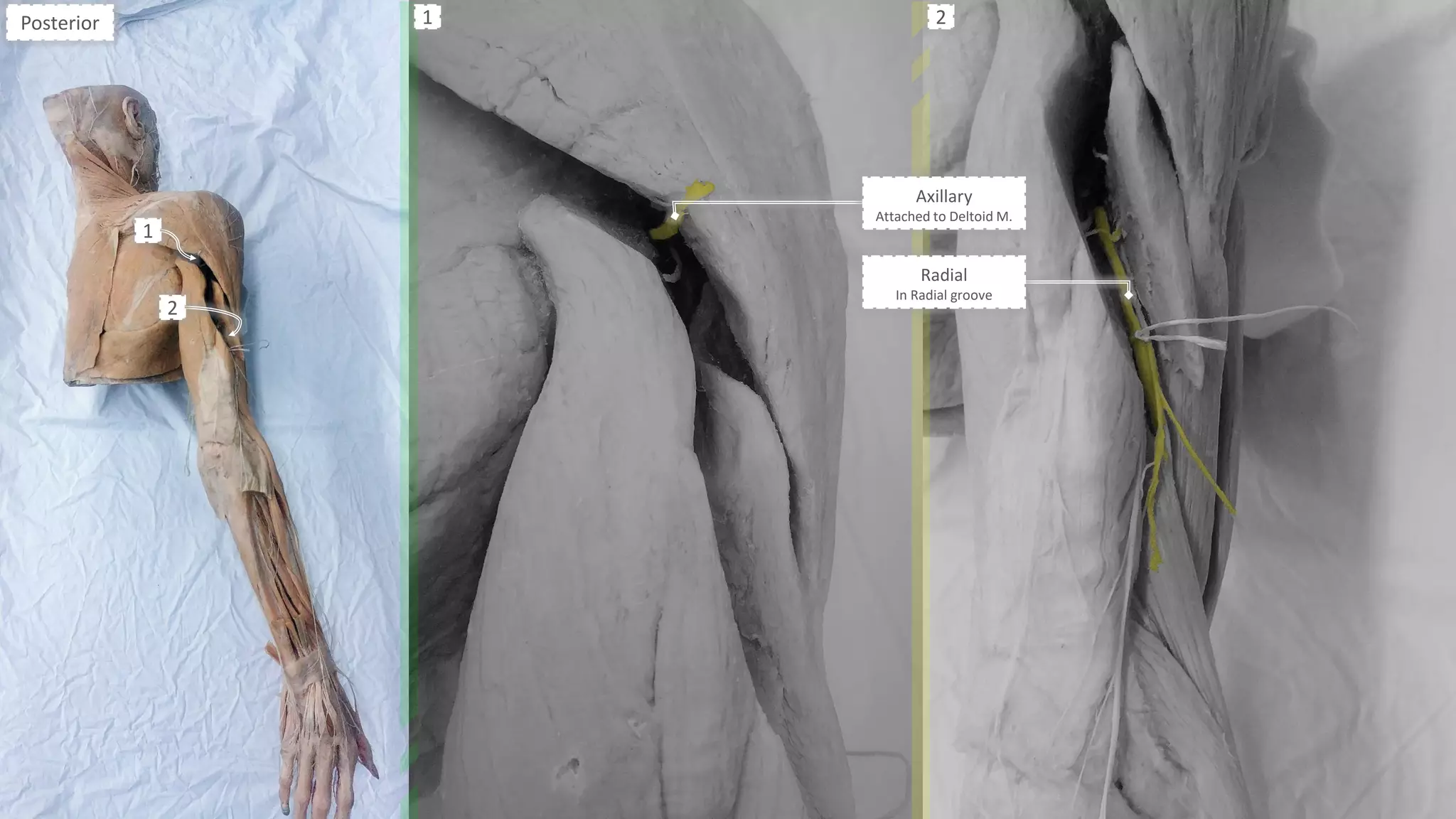 Axillary
Attached to Deltoid M.
Radial
In Radial groove
Posterior
1
2
1 2
 