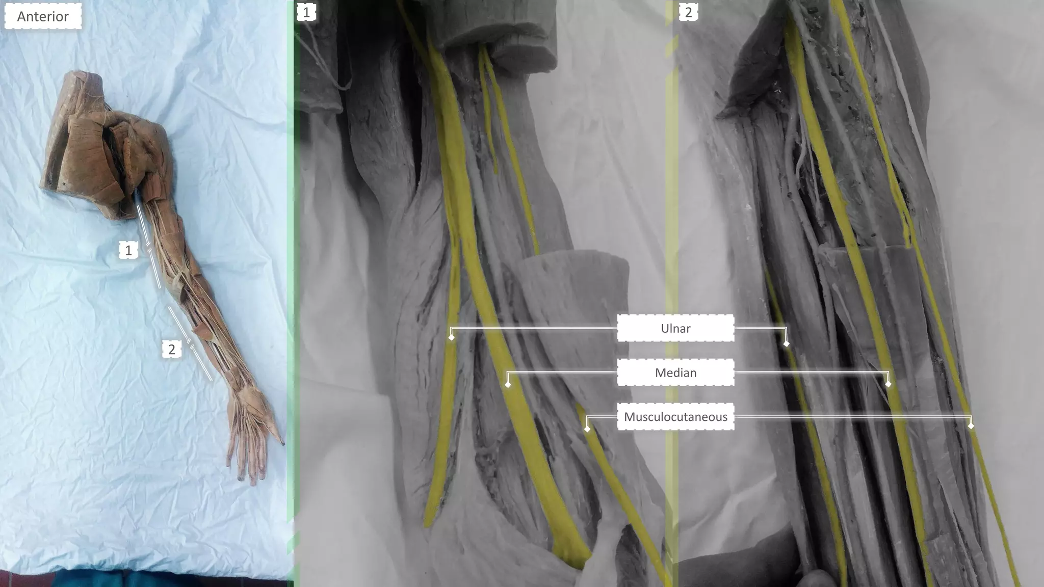 Ulnar
Median
Musculocutaneous
Anterior
1
2
1 2
 