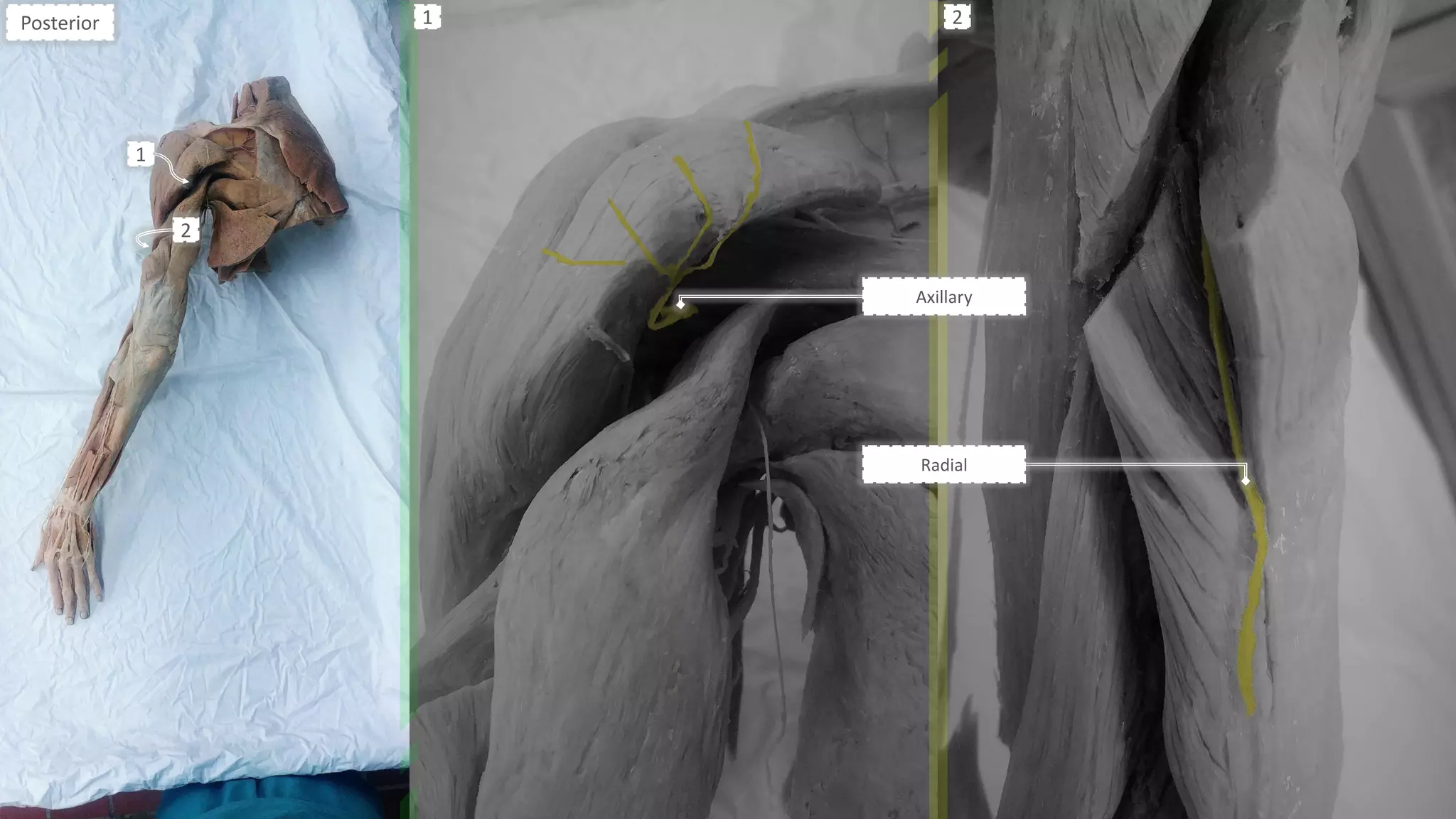 Axillary
Radial
Posterior
1
1 2
2
 