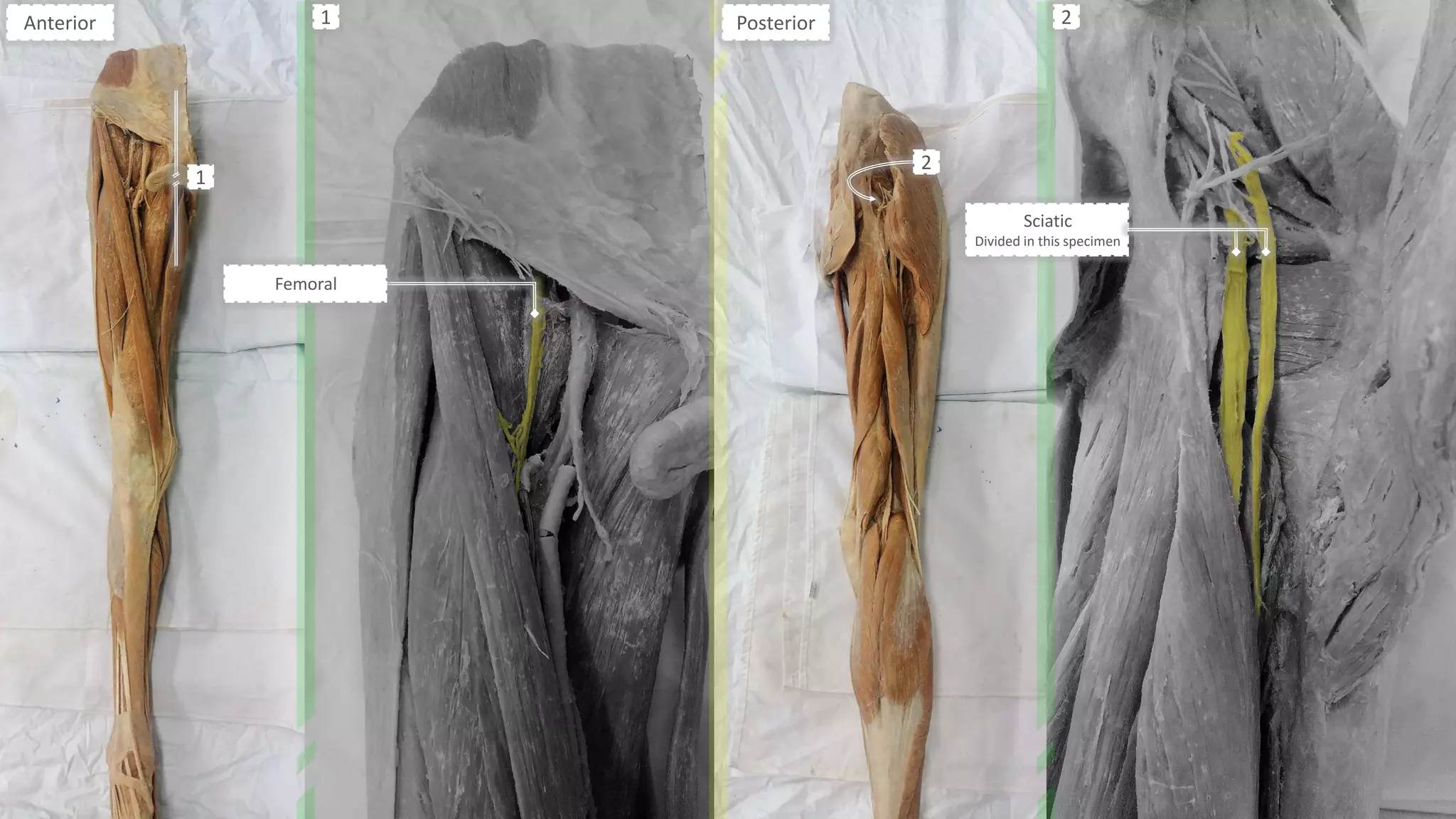 Sciatic
Divided in this specimen
Femoral
PosteriorAnterior
1
2
1 2
 