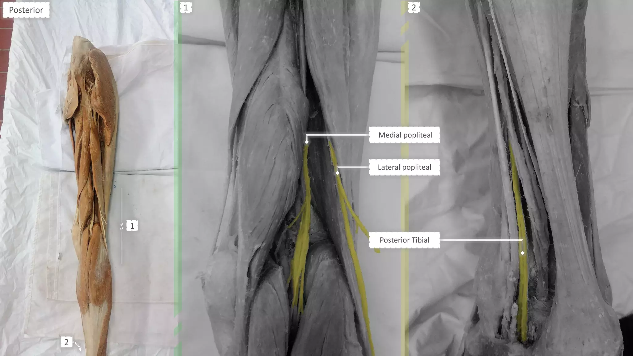 Medial popliteal
Lateral popliteal
Posterior
2
1
1 2
Posterior Tibial
 