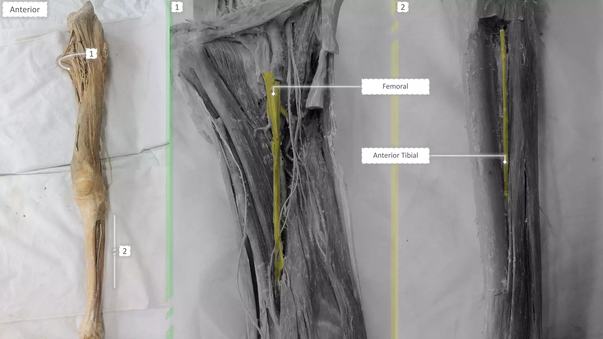 Femoral
Anterior Tibial
Anterior
1
2
1 2
 