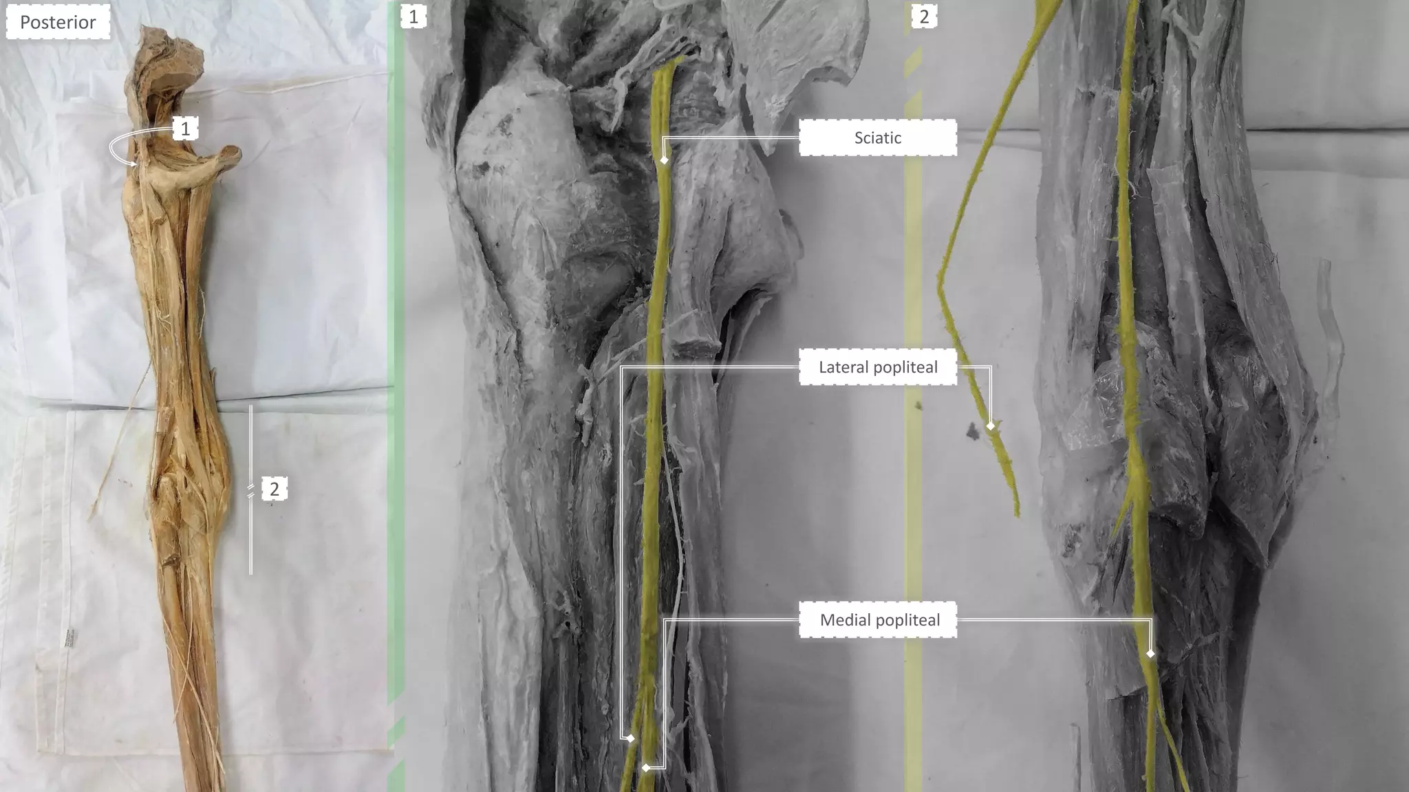 Sciatic
Lateral popliteal
Medial popliteal
Posterior
1
2
1 2
 