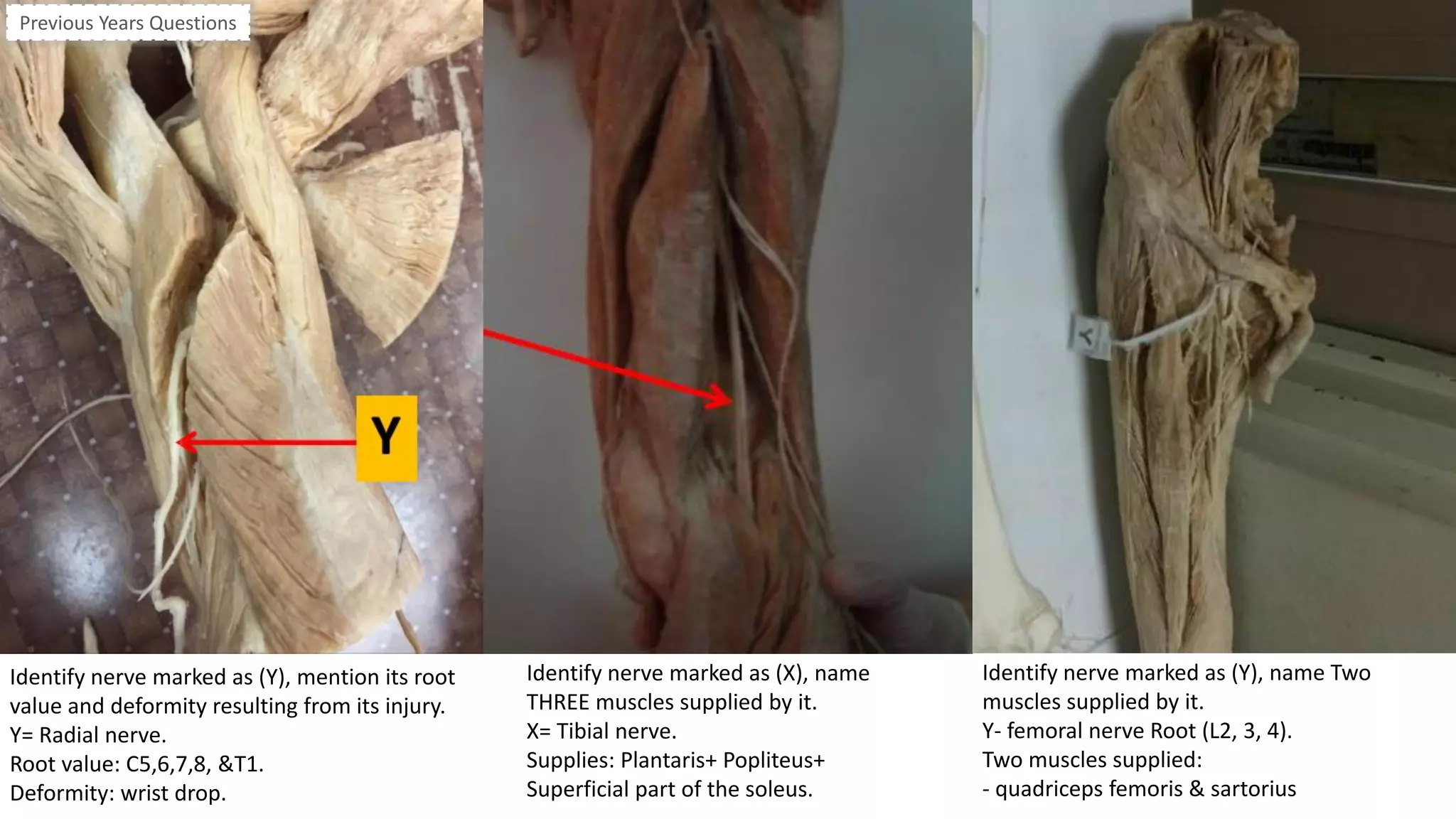 Identify nerve marked as (Y), mention its root
value and deformity resulting from its injury.
Y= Radial nerve.
Root value: C5,6,7,8, &T1.
Deformity: wrist drop.
Identify nerve marked as (X), name
THREE muscles supplied by it.
X= Tibial nerve.
Supplies: Plantaris+ Popliteus+
Superficial part of the soleus.
Identify nerve marked as (Y), name Two
muscles supplied by it.
Y- femoral nerve Root (L2, 3, 4).
Two muscles supplied:
- quadriceps femoris & sartorius
Previous Years Questions
 