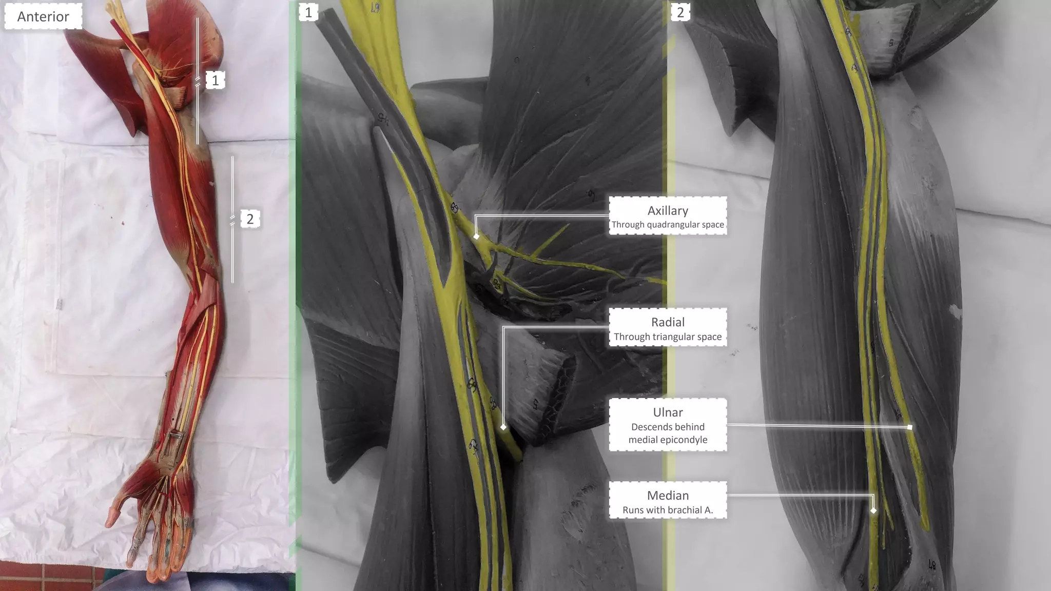 Median
Runs with brachial A.
Radial
Through triangular space
Anterior
1
2
1 2
Ulnar
Descends behind
medial epicondyle
Axillary
Through quadrangular space
 