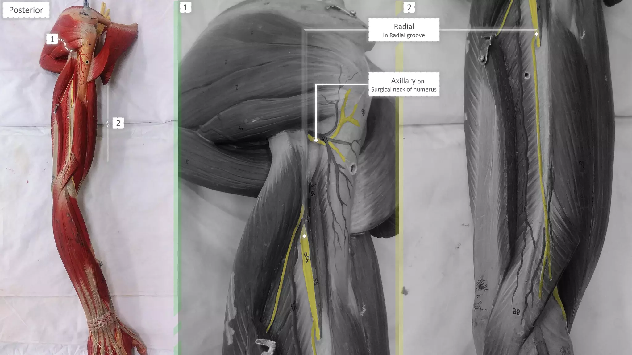 Radial
In Radial groove
Axillary on
Surgical neck of humerus
-
Posterior
1
2
1 2
 