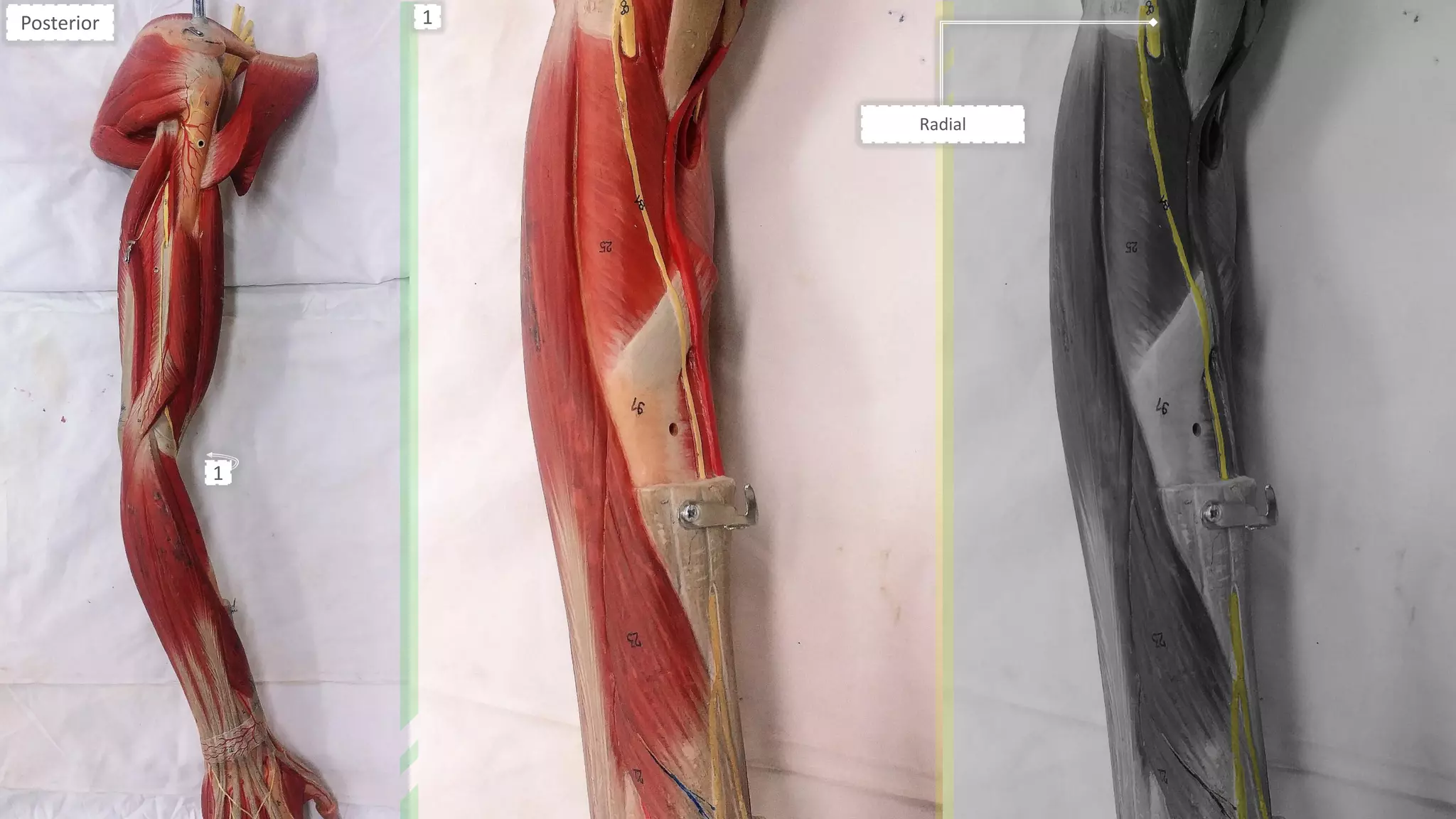 Radial
Posterior
1
1
 