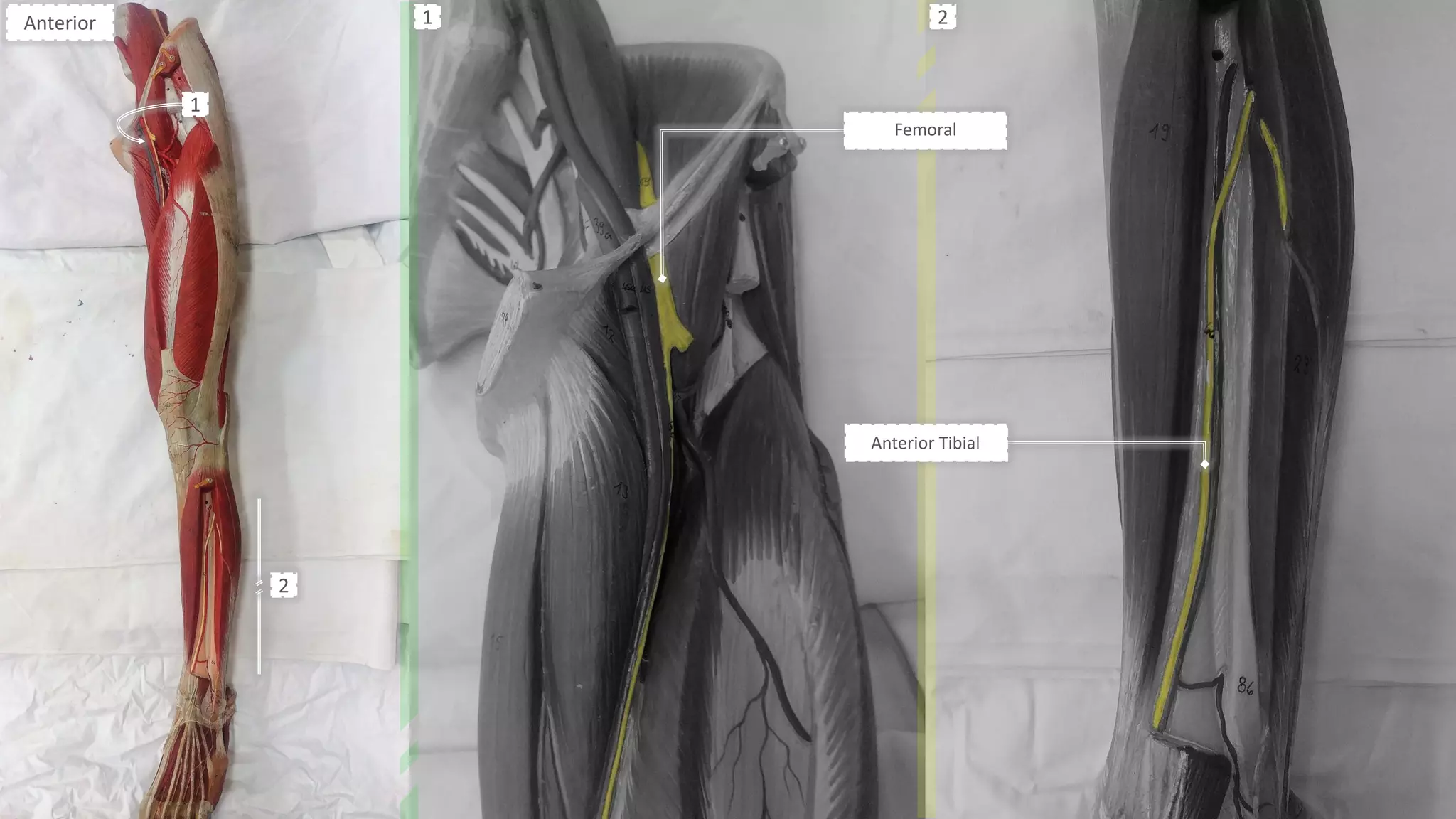 Femoral
Anterior Tibial
Anterior
1
2
1 2
 