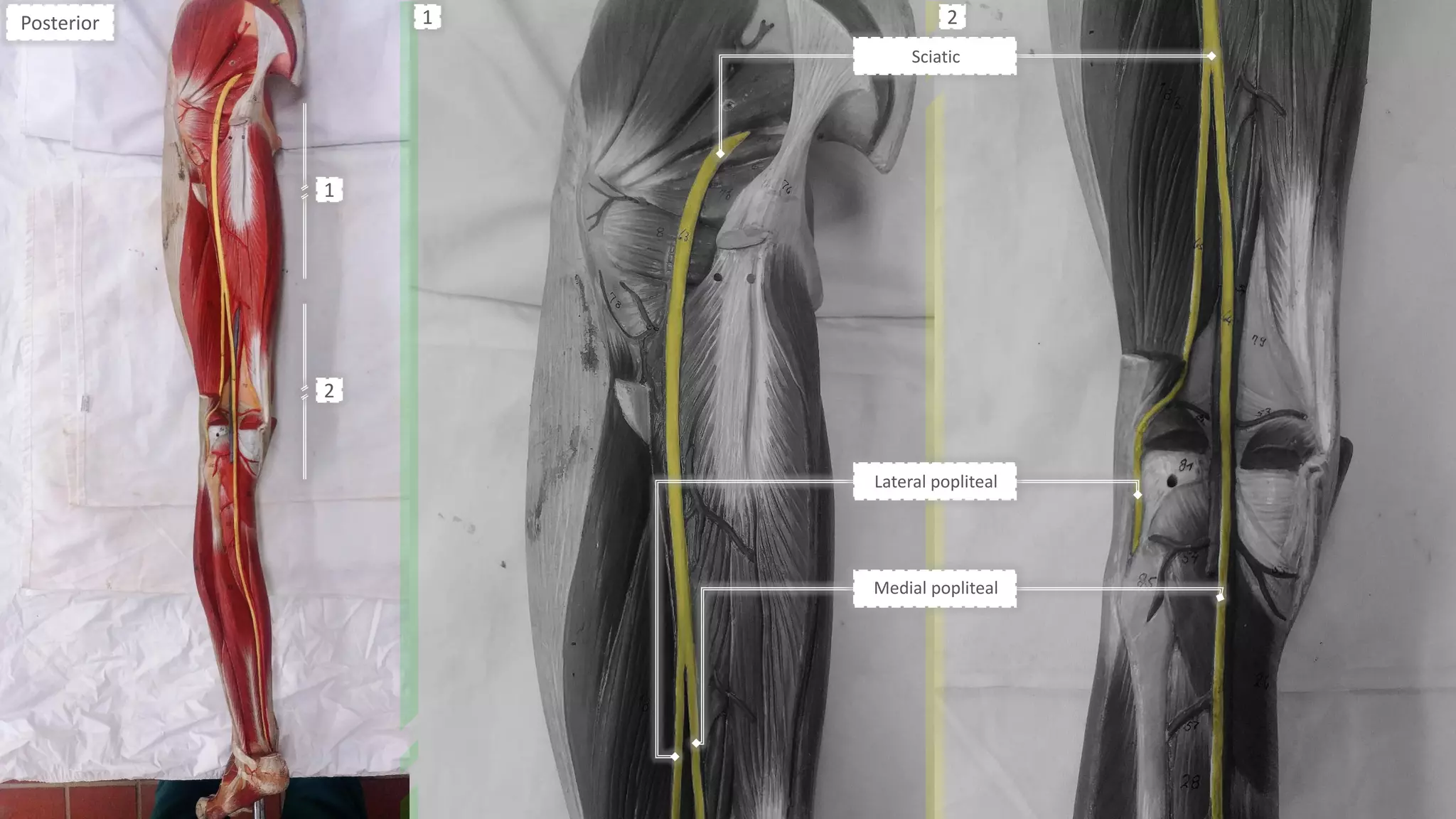 Sciatic
Lateral popliteal
Medial popliteal
Posterior
1
2
1 2
 