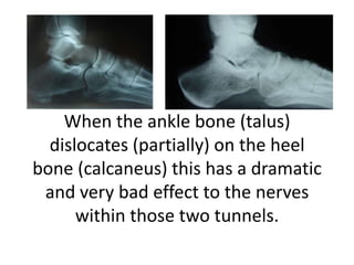 When the ankle bone (talus)
dislocates (partially) on the heel
bone (calcaneus) this has a dramatic
and very bad effect to...