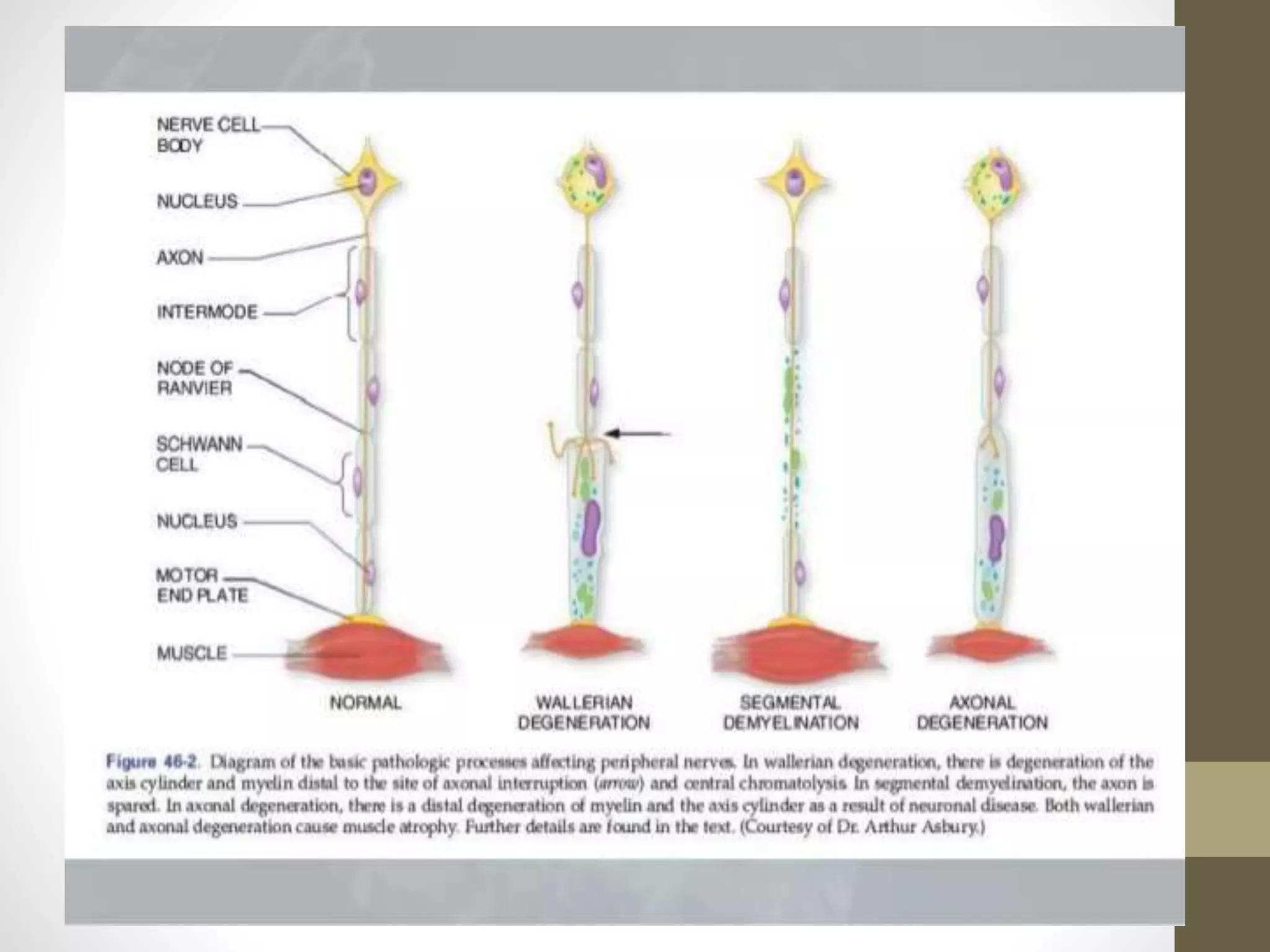 Approach to Peripheral neuropathy | PPTX