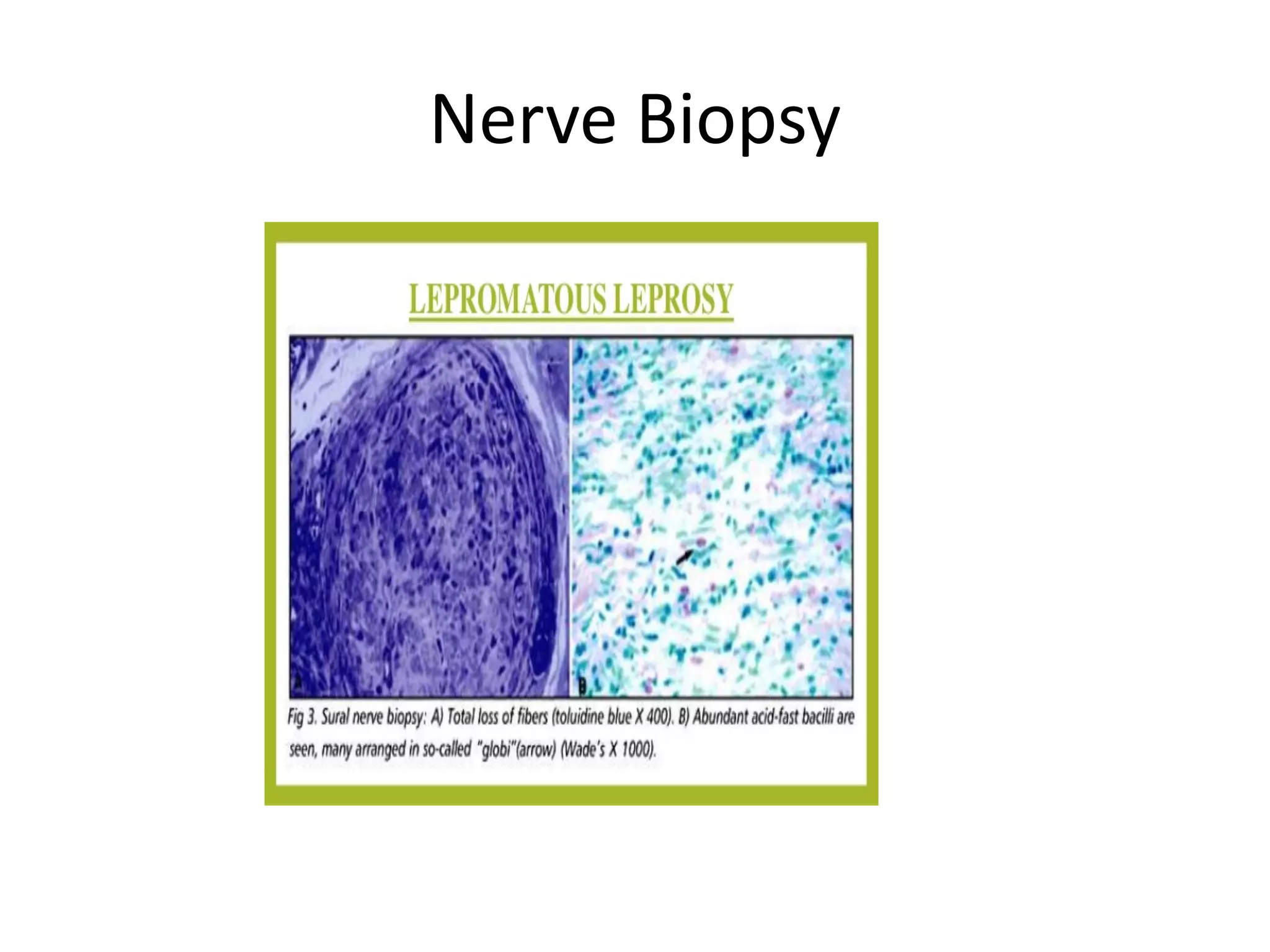 Nerve Biopsy
 