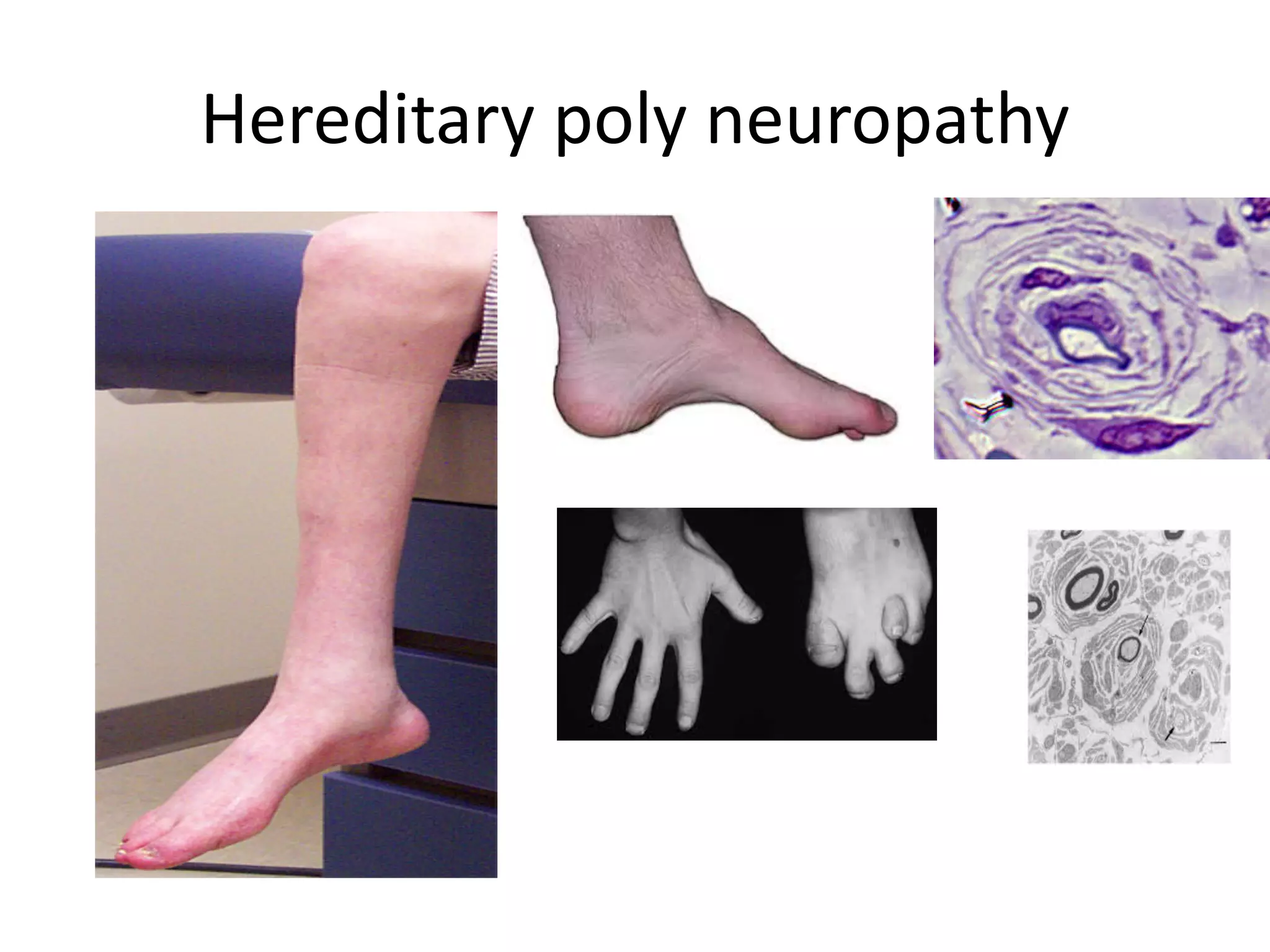 Hereditary poly neuropathy
 