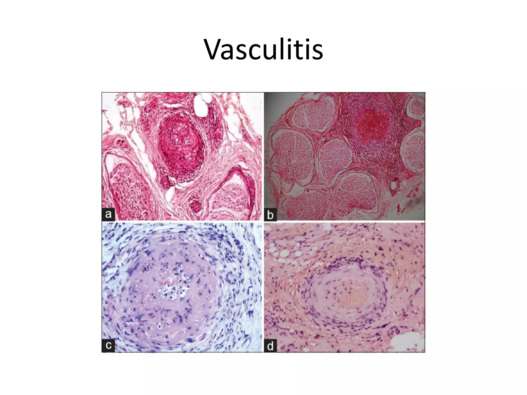 Vasculitis
 