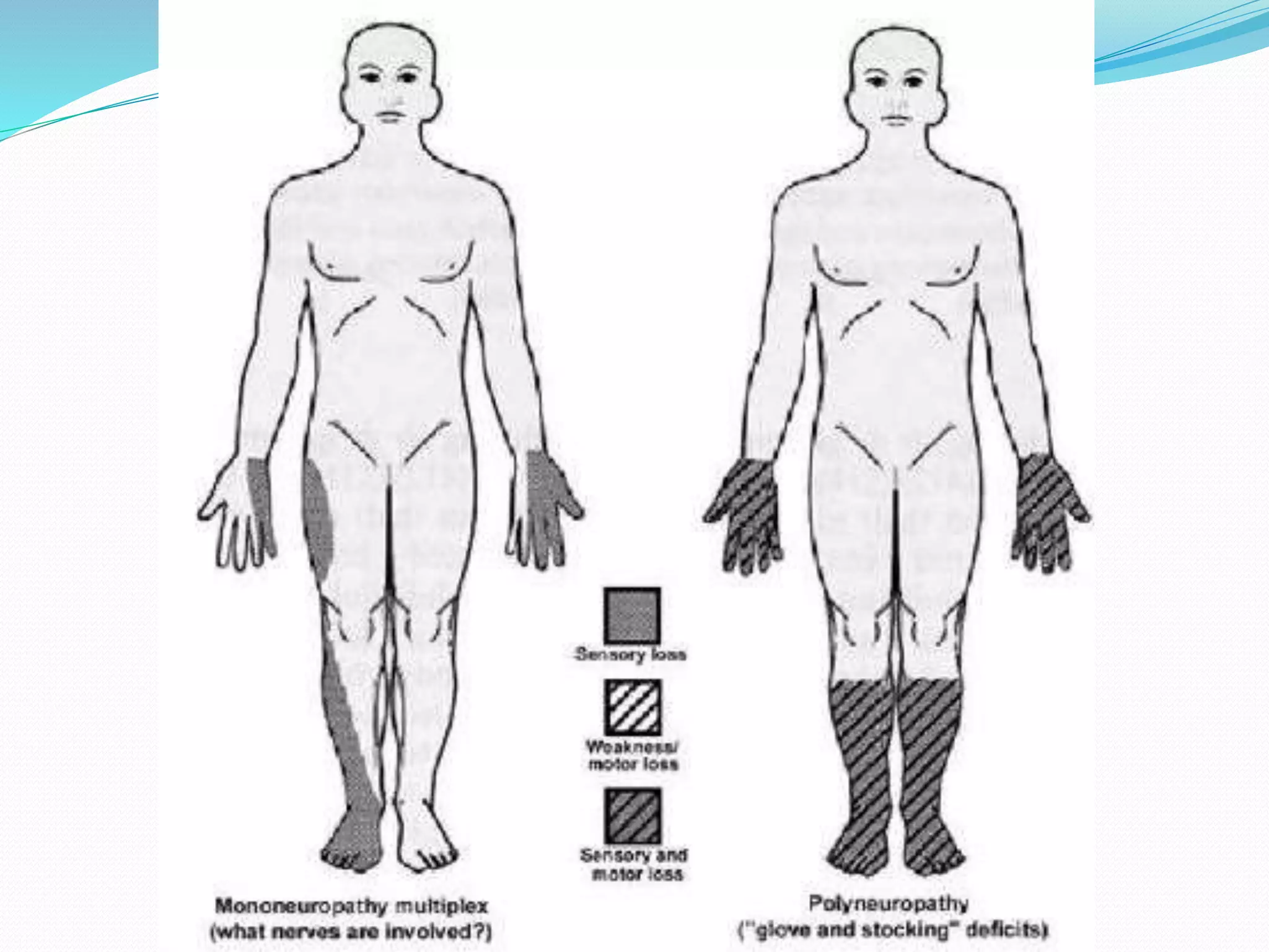 Peripheral neuropathy Anatomy, Physiology and Diseases