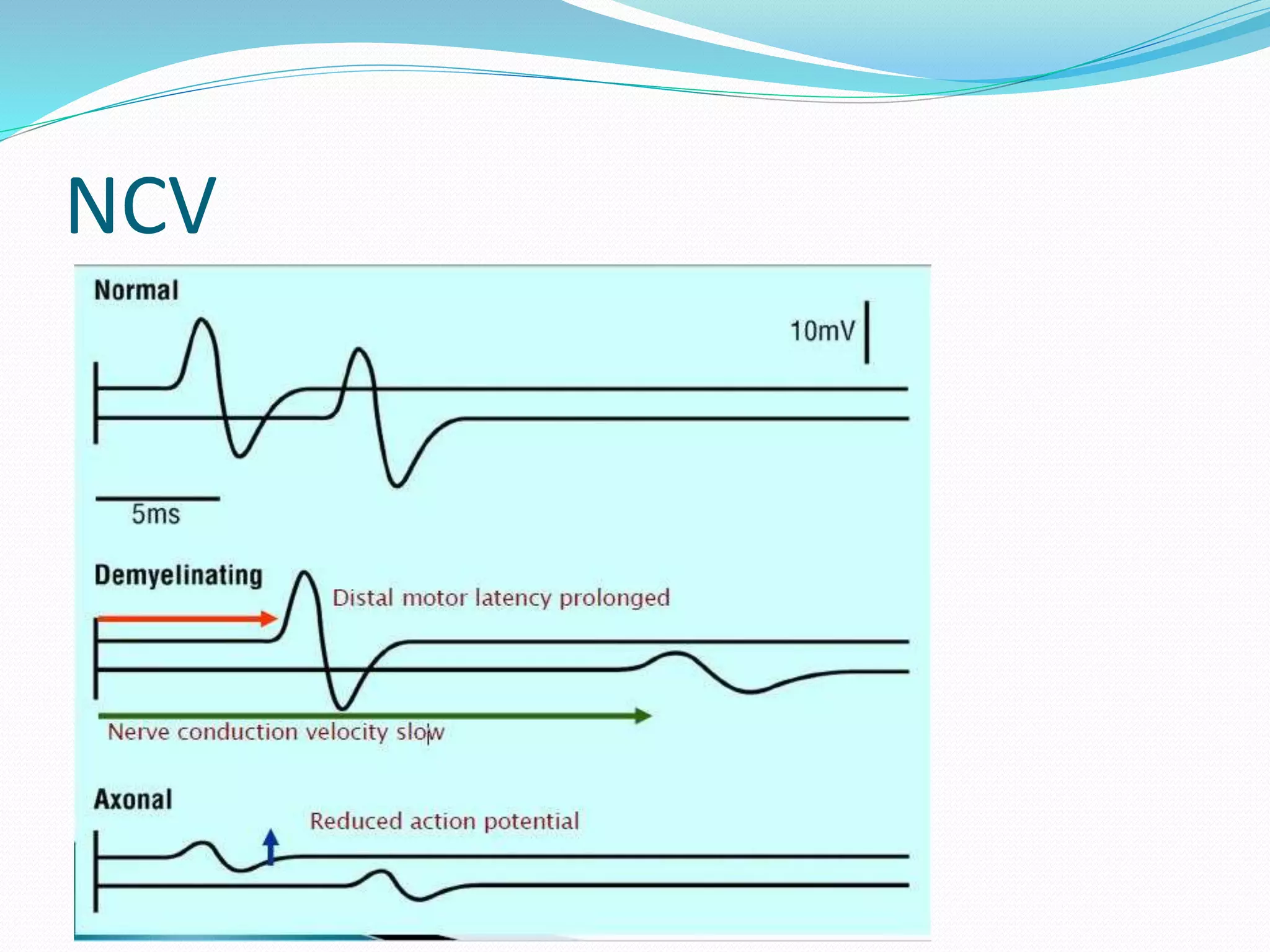 Peripheral neuropathy Anatomy, Physiology and Diseases