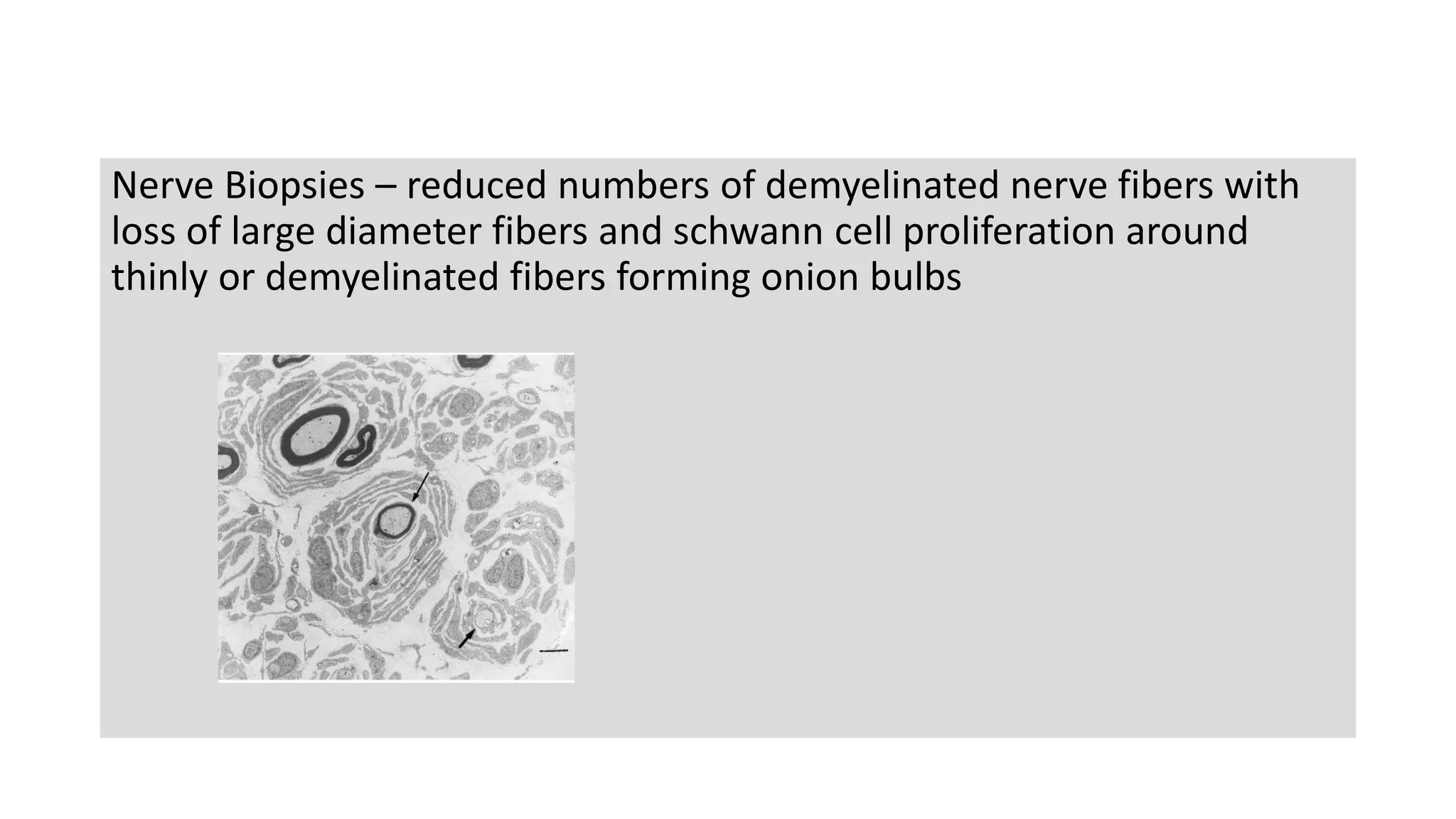 Nerve Biopsies – reduced numbers of demyelinated nerve fibers with
loss of large diameter fibers and schwann cell proliferation around
thinly or demyelinated fibers forming onion bulbs
 