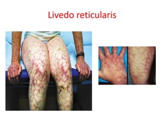 Indeo Reticularis Peripheral neuropathy in systemic disease children | PPTX