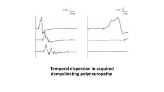 Temporal dispersion in acquired
demyelinating polyneuropathy
 