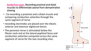 borderline cases. Recording proximal and distal
muscles to differentiate axonal from demyelinative
slowing
• . Co-recording a proximal and a distal muscle and
comparing conduction velocities through the
same segment of nerve
• recording electrodes are placed over the tibialis
anterior and extensor digitorum brevis
• The peroneal nerve is stimulated below the
fibular neck and at the lateral popliteal fossa and
conduction velocities computed across the same
segment of nerve for the two recording sites.
 