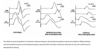 This distal-to-proximal gradient of conduction velocity slowing in axonal polyneuropathies may be very helpful in differentiating a
primary demyelinating from axonal polyneuropathy, especially when the distal conduction velocities are near the cutoff value for
demyelinative slowing.
 
