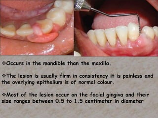 Occurs in the mandible than the maxilla.
The lesion is usually firm in consistency it is painless and
the overlying epithelium is of normal colour.
Most of the lesion occur on the facial gingiva and their
size ranges between 0.5 to 1.5 centimeter in diameter
 