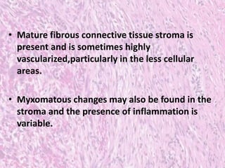 • Mature fibrous connective tissue stroma is
present and is sometimes highly
vascularized,particularly in the less cellular
areas.
• Myxomatous changes may also be found in the
stroma and the presence of inflammation is
variable.
 