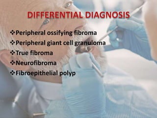 Peripheral ossifying fibroma
Peripheral giant cell granuloma
True fibroma
Neurofibroma
Fibroepithelial polyp
 