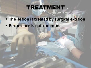 • The lesion is treated by surgical excision
• Recurrence is not common.
 