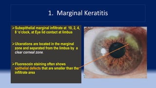 1. Marginal Keratitis
Subepithelial marginal infiltrate at 10, 2, 4,
8 ‘o’clock, at Eye lid contact at limbus
Ulcerations are located in the marginal
zone and separated from the limbus by a
clear corneal zone.
Fluorescein staining often shows
epithelial defects that are smaller than the
infiltrate area
 