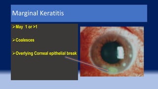 Marginal Keratitis
May 1 or >1
Coalesces
Overlying Corneal epithelial break
 