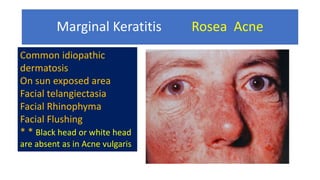 Marginal Keratitis Rosea Acne
Common idiopathic
dermatosis
On sun exposed area
Facial telangiectasia
Facial Rhinophyma
Facial Flushing
* * Black head or white head
are absent as in Acne vulgaris
 